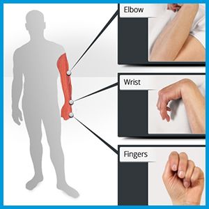 Post Stroke Spasticity